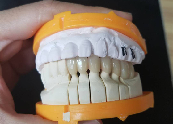 Corone ceramiche su ordinazione di dimensione PFM per i denti posteriori ed anteriori
