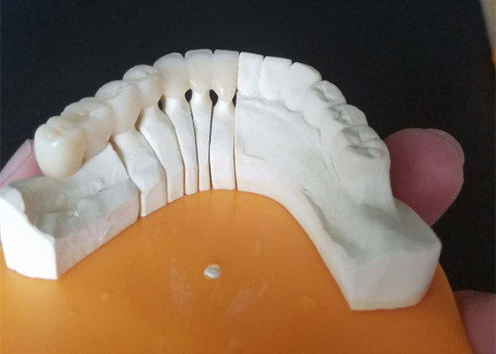 Corone ceramiche su ordinazione di dimensione PFM per i denti posteriori ed anteriori