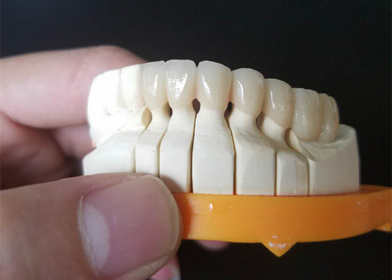 Corone ceramiche su ordinazione di dimensione PFM per i denti posteriori ed anteriori