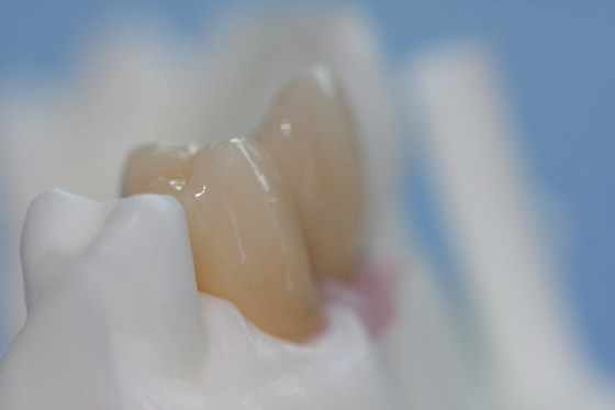 Appoggio su ordinazione puro smontabile di Antivari dell'impianto dentario del titanio