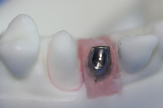 Appoggio su ordinazione puro smontabile di Antivari dell'impianto dentario del titanio