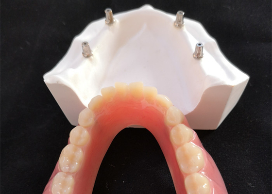 L'impianto dentario comodo Overdenture di camma di cad facile mantiene