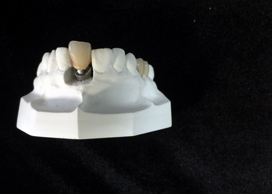 Alta protesi dentaria del collegamento di Antivari di stabilità degli indicatori di posizione su ordinazione dell'impianto dentario