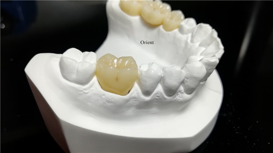 Corone dentali in ceramica, corone dentali in zirconia