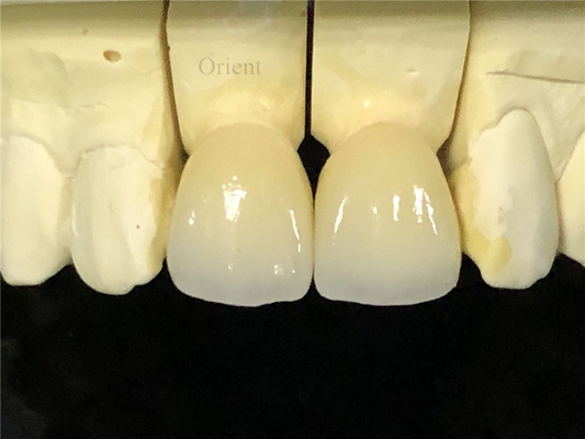 Corone dentali in ceramica, corone dentali in zirconia