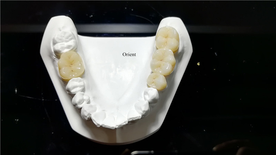 Corone dentali in ceramica, corone dentali in zirconia