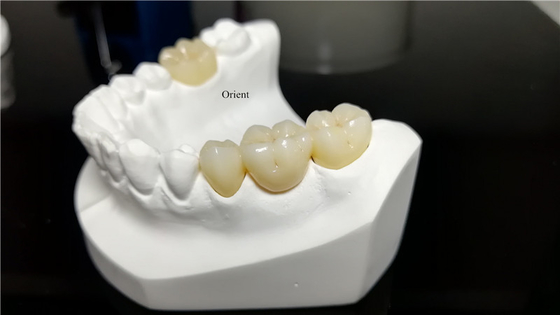 Corone dentali in ceramica, corone dentali in zirconia