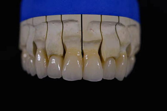 Laboratorio di fabbricazione di protesi ottenendo protesi perfettamente bianche con riparazione di zirconia