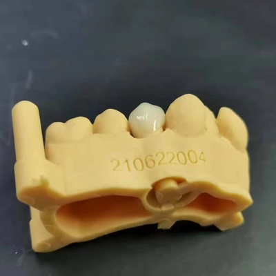 Progettazione digitale + stampa del modello + corona di zirconia