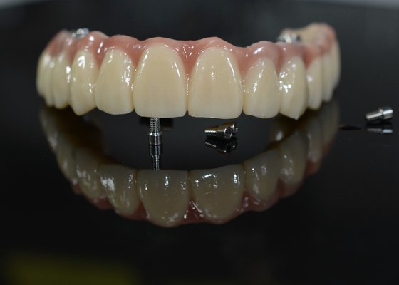 Corona dentale in zirconia: denti di aspetto naturale, durevoli e sicuri