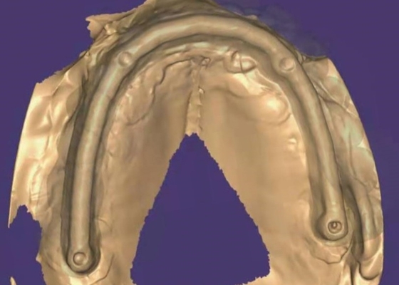 Corona dentale in zirconia: denti di aspetto naturale, durevoli e sicuri