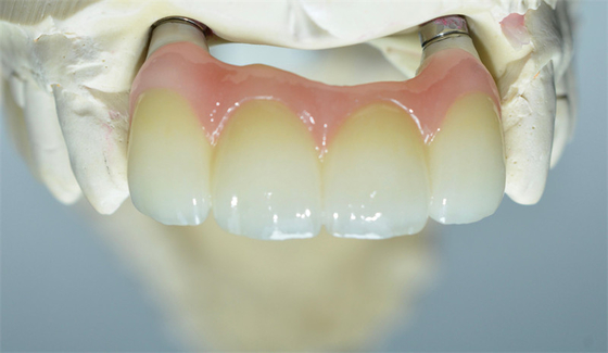Forte base del Ti che macina il ponte di sostegno dente delle corone dell'impianto dentario