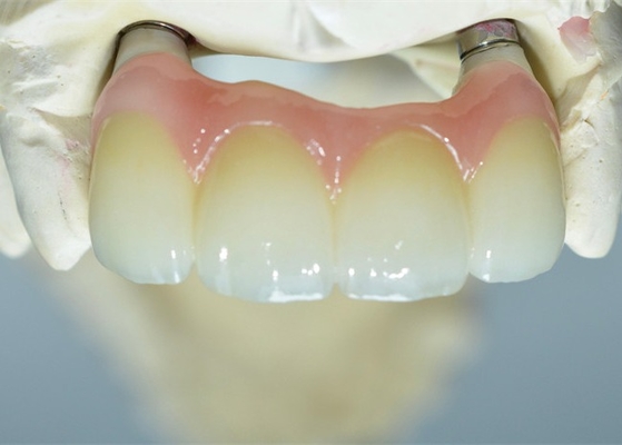Forte base del Ti che macina il ponte di sostegno dente delle corone dell'impianto dentario