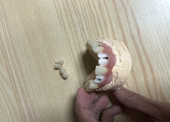 Corona accurata dell'impianto del dente dei collegamenti dell'impianto dentario di biocompatibilità