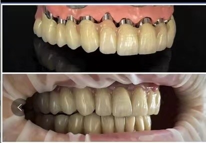 Impianti dentali Telescopio PFM ponte in porcellana