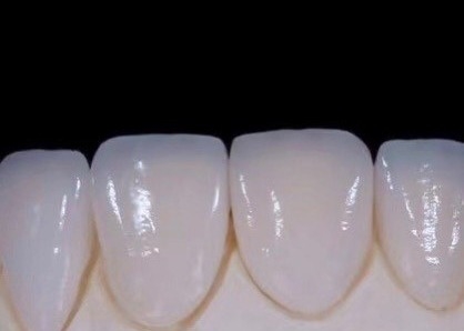 EMAX Durabilità Finiture dentistiche composite CAD/CAM Altamente dettagliate Accurate