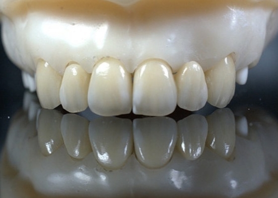 EMAX Durabilità Finiture dentistiche composite CAD/CAM Altamente dettagliate Accurate