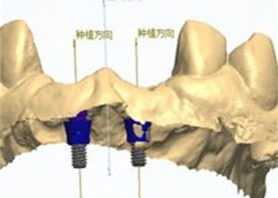 Modello 3D Corona di zirconia