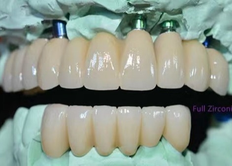 OEM Impianto circonico corona dentale ponte fisso