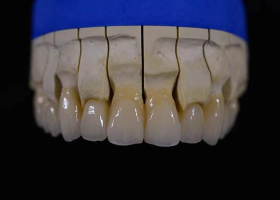 Il biossido di zirconio dentario di ripristino della corona di biossido di zirconio pieno della bocca ha riparato la resistenza chimica del ponte