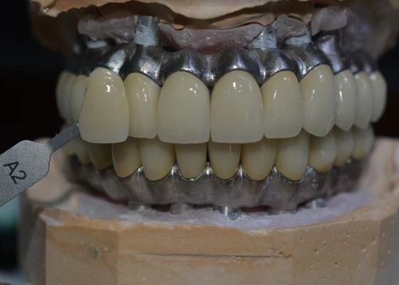 Materiale biologico della corona del metallo di sostegno impianto resistente alla corrosione del Cr di Co