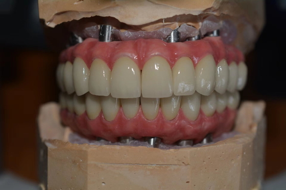 Corone per impianti dentali di precisione per il comfort e la sicurezza