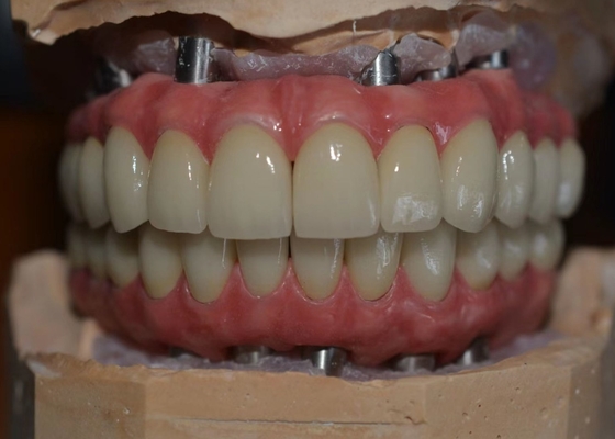 Materiale biologico della corona del metallo di sostegno impianto resistente alla corrosione del Cr di Co