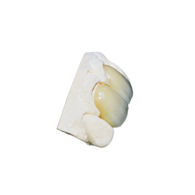 Corone dentali in zirconia fabbricate con l'ausilio di un computer con colore naturale e elevata resistenza