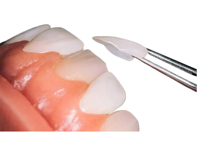 Ditta dentaria su ordinazione dell'impiallacciatura della porcellana dell'OEM resistente all'uso per ripristino dentario