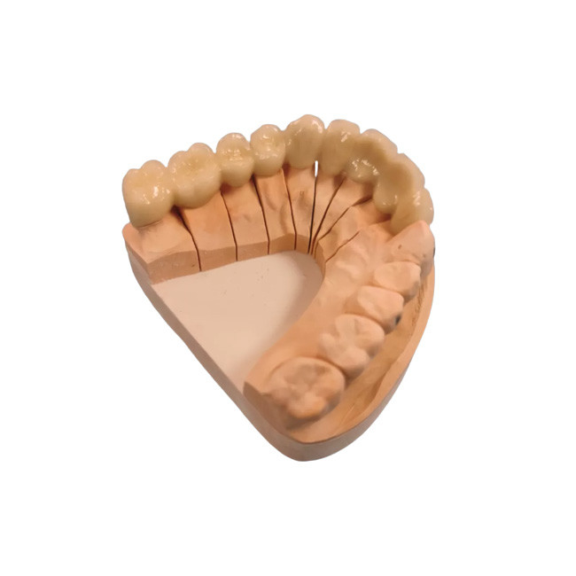 Superficie regolare del metallo della porcellana della corona PFM della corona della stalla dentaria ad alta resistenza di colore