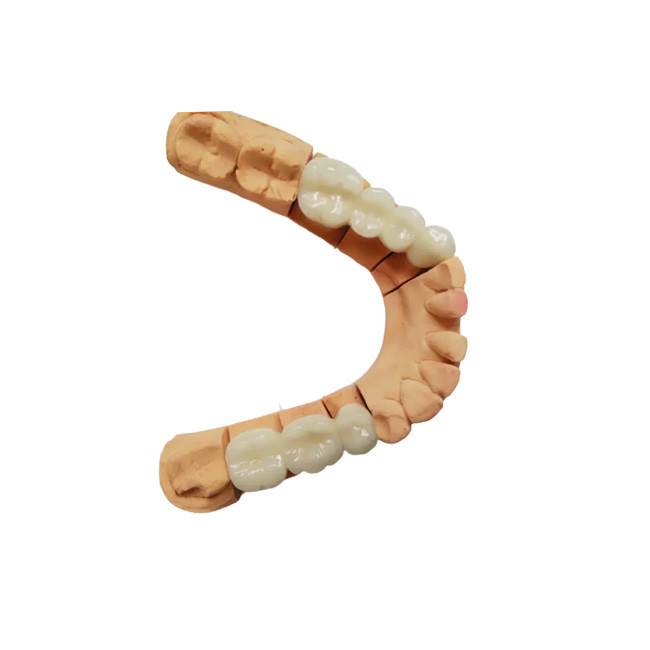 Corona dentale PFM di alta qualità Aspetto realistico Colore stabile Non facile da indossare