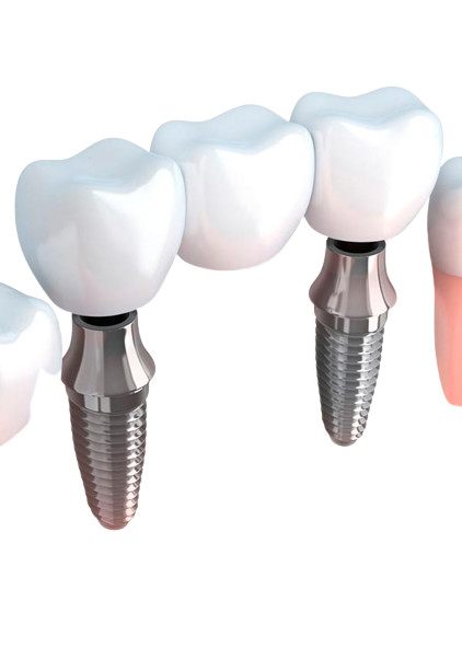 Ponti realistici di aspetto e colore naturale stabilità dentaria delle corone di forte