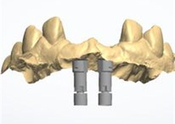 Modello 3D Corona di zirconia